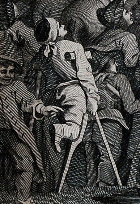 A black and white drawing of a man using two crutches under his armpits, and another to brace his knee in lieu of his lower leg.